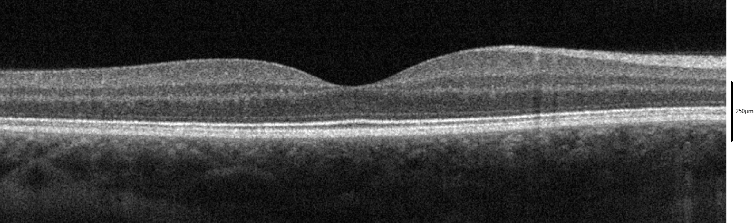Scansione OCT della macula di un occhio normale: si evidenzia la tipica depressione foveale e gli strati retinici